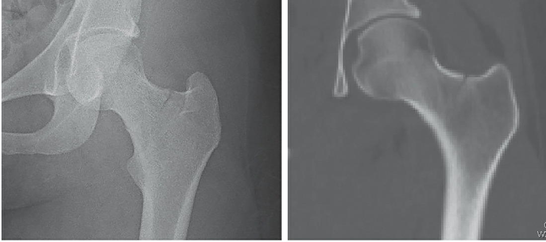 Fonte: Rockwood and Green's Fractures in Adults, 10ª ed., capítulo 24, figura 24-8A.