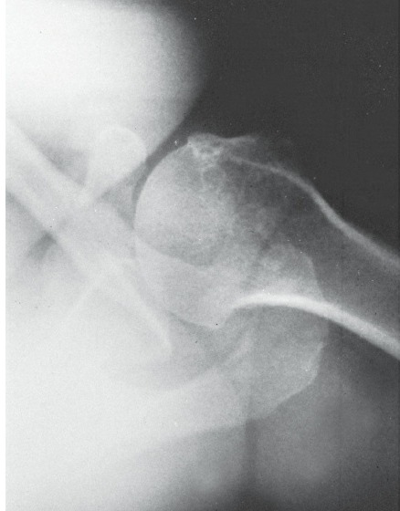 Fonte: Rockwood and Green's Fractures in Adults, 10ª ed., capítulo 32, figura 32-25A.