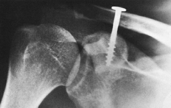Fonte: Rockwood and Green's Fractures in Adults, 10ª ed., capítulo 32, figura 32-36.