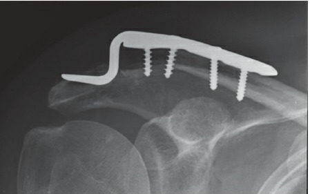 Fonte: Rockwood and Green's Fractures in Adults, 10ª ed., capítulo 32, figura 32-51D.