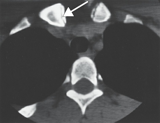 Fonte: Rockwood and Green's Fractures in Adults, 10ª ed., capítulo 32, figura 32-5.
