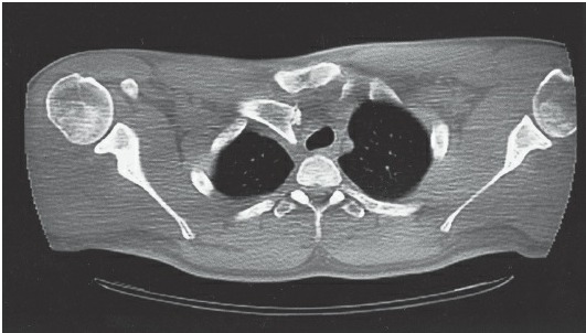 Fonte: Rockwood and Green's Fractures in Adults, 10ª ed., capítulo 32, figura 32-17B.
