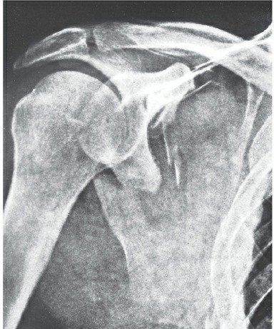 Fonte: Rockwood and Green's Fractures in Adults, 10ª ed., capítulo 33, figura 33-26A.