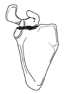 Fonte: Rockwood and Green's Fractures in Adults, 10ª ed., capítulo 33, figura 33-9.