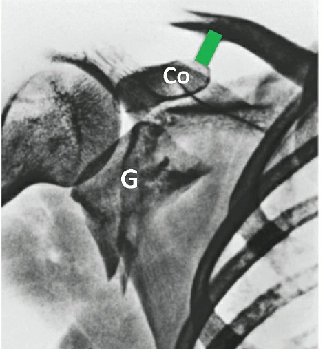 Fonte: Rockwood and Green's Fractures in Adults, 10ª ed., capítulo 33, figura 33-13D.