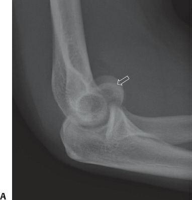 Fonte: Rockwood and Green's Fractures in Adults, 10ª ed., capítulo 39, figura 39-31A.