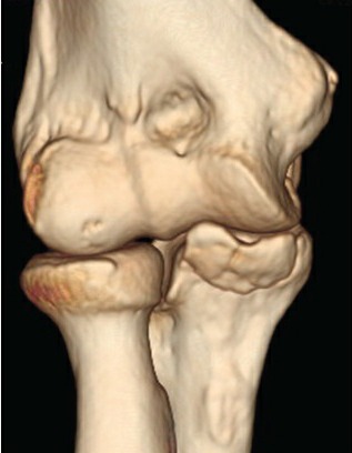 Fonte: Rockwood and Green's Fractures in Adults, 10ª ed., capítulo 40, figura 40-19C.