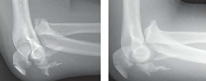 Fonte: Rockwood and Green's Fractures in Adults, 10ª ed., capítulo 40, figura 40-23A e B.