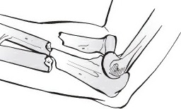 Fonte: Rockwood and Green's Fractures in Adults, 10ª ed., capítulo 42, figura 42-12.