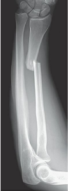 Fonte: Rockwood and Green's Fractures in Adults, 10ª ed., capítulo 42, figura 42-7A.