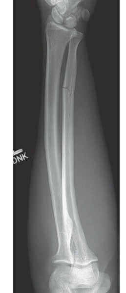 Fonte: Rockwood and Green's Fractures in Adults, 10ª ed., capítulo 42, figura 42-3A.