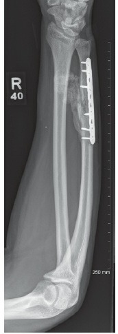 Fonte: Rockwood and Green's Fractures in Adults, 10ª ed., capítulo 42, figura 42-34C.