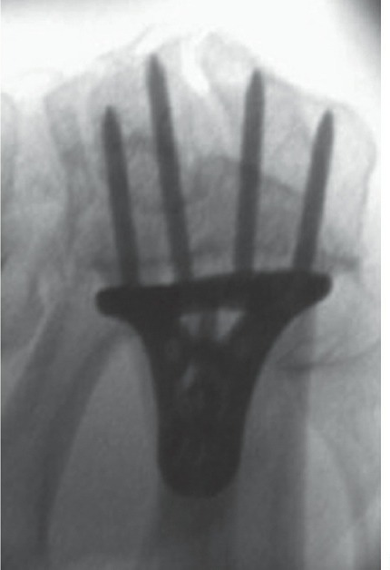 Fonte: Rockwood and Green's Fractures in Adults, 10ª ed., capítulo 43, figura 43-1B.