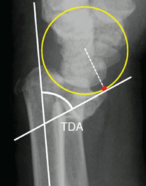 Fonte: Rockwood and Green's Fractures in Adults, 10ª ed., capítulo 43, figura 43-3.