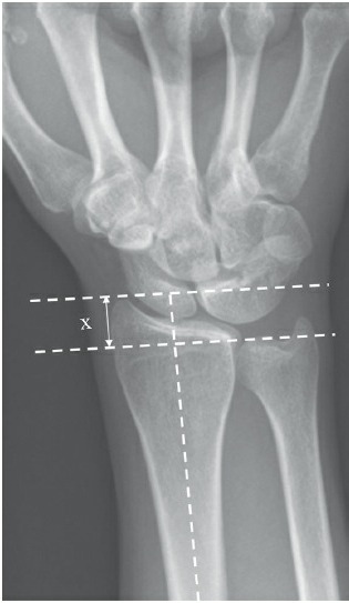 Fonte: Rockwood and Green's Fractures in Adults, 10ª ed., capítulo 43, figura 43-2A.