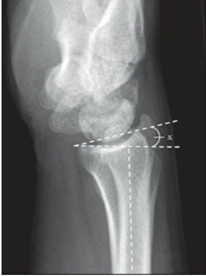 Fonte: Rockwood and Green's Fractures in Adults, 10ª ed., capítulo 43, figura 43-2C.