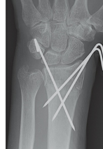 Fonte: Rockwood and Green's Fractures in Adults, 10ª ed., capítulo 43, figura 43-6A.