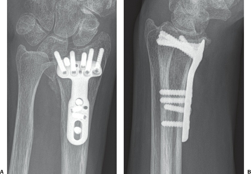Fonte: Rockwood and Green's Fractures in Adults, 10ª ed., capítulo 43, figura 43-11.