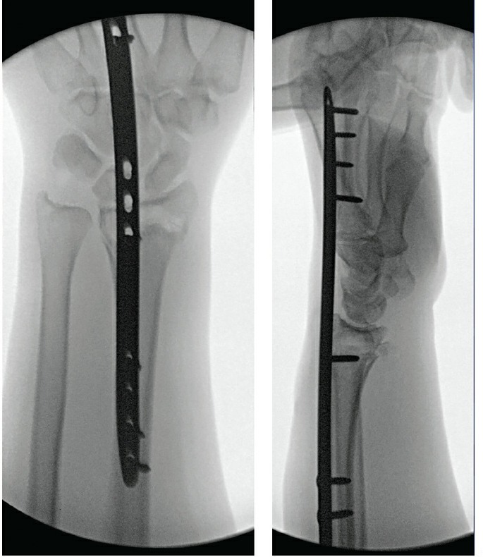 Fonte: Rockwood and Green's Fractures in Adults, 10ª ed., capítulo 43, figura 43-17B e C.