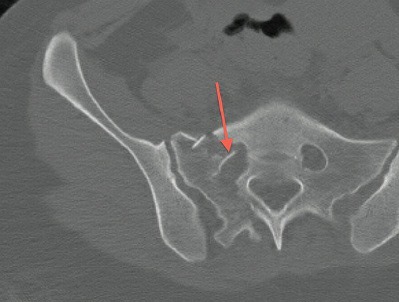 Fonte: Rockwood and Green's Fractures in Adults, 10ª ed., capítulo 50, figura 50-22.