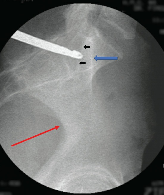 Fonte: Rockwood and Green's Fractures in Adults, 10ª ed., capítulo 50, figura 50-66.