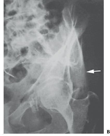 Fonte: Rockwood and Green's Fractures in Adults, 10ª ed., capítulo 51, figura 51-37B.