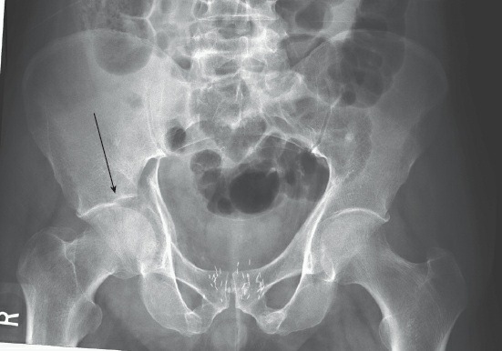 Fonte: Rockwood and Green's Fractures in Adults, 10ª ed., capítulo 51, figura 51-29.