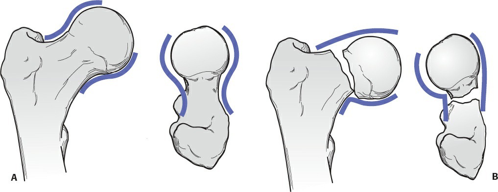 Fonte: Rockwood and Green's Fractures in Adults, 10ª ed., capítulo 53, figura 53-12.