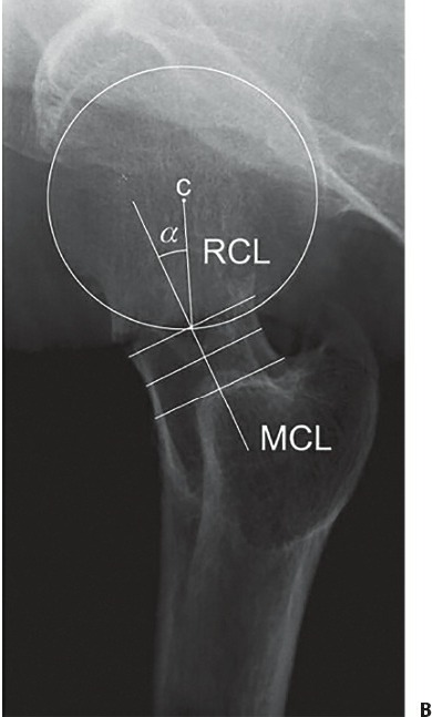 Fonte: Rockwood and Green's Fractures in Adults, 10ª ed., capítulo 53, figura 53-7.