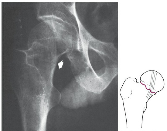Fonte: Rockwood and Green's Fractures in Adults, 10ª ed., capítulo 53, figura 53-4A.