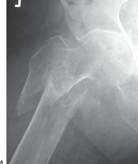 Fonte: Rockwood and Green's Fractures in Adults, 10ª ed., capítulo 54, figura 54-11A.