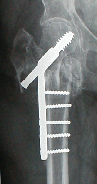 Fonte: Rockwood and Green's Fractures in Adults, 10ª ed., capítulo 54, figura 54-12.