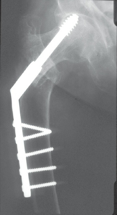 Fonte: Rockwood and Green's Fractures in Adults, 10ª ed., capítulo 54, figura 54-24.