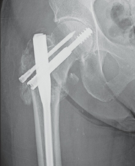 Fonte: Rockwood and Green's Fractures in Adults, 10ª ed., capítulo 54, figura 54-36.