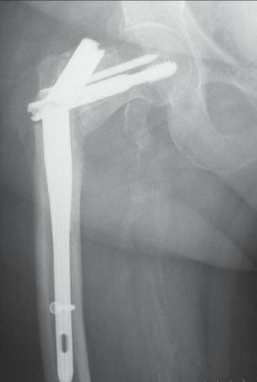 Fonte: Rockwood and Green's Fractures in Adults, 10ª ed., capítulo 54, figura 54-38.
