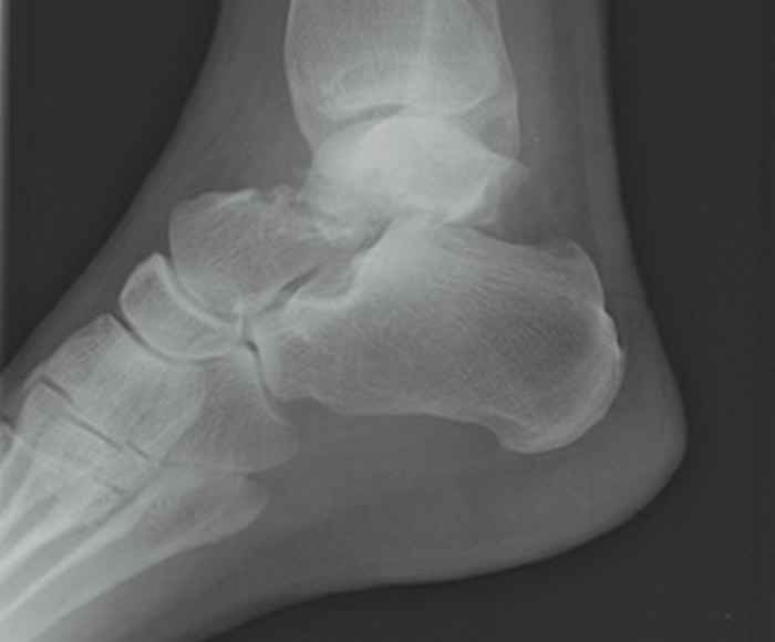 Fonte: Rockwood and Green's Fractures in Adults, 10ª ed., capítulo 66, figura 66-16B.