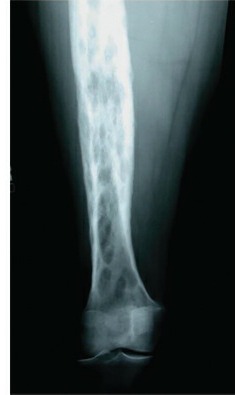 Fonte: Rockwood and Green's Fractures in Adults, 10ª ed., capítulo 25, figura 25-1B.