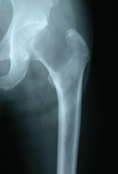 Fonte: Rockwood and Green's Fractures in Adults, 10ª ed., capítulo 25, figura 25-3.